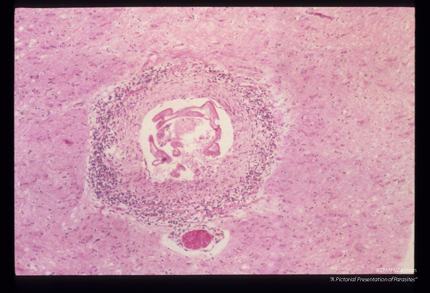 Same case. CNS atrophy, sclerosis, and larval granuloma in brain are shown.