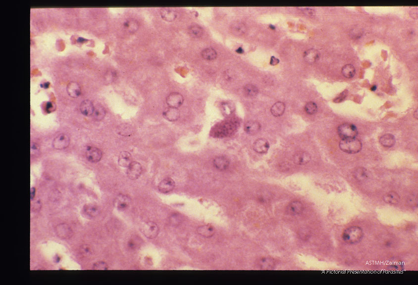 A cardiac recipient received a heart which harbored Toxoplasma and died thereof. Prior to transplantation his serology was negative for Toxoplasma. The parasites are readily visualized in his liver.