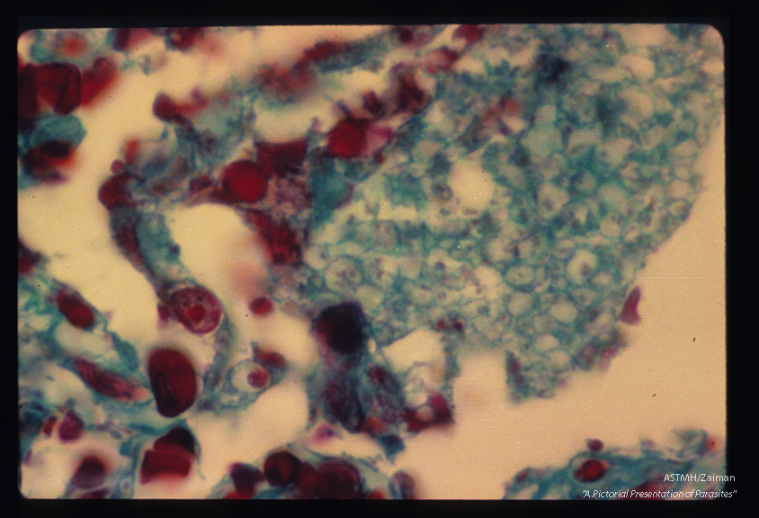 Pneumonia. Oil immersion view of alveolus stained by the Wheatly modification of trichrome for stools showing macrophage invasion and parasites.