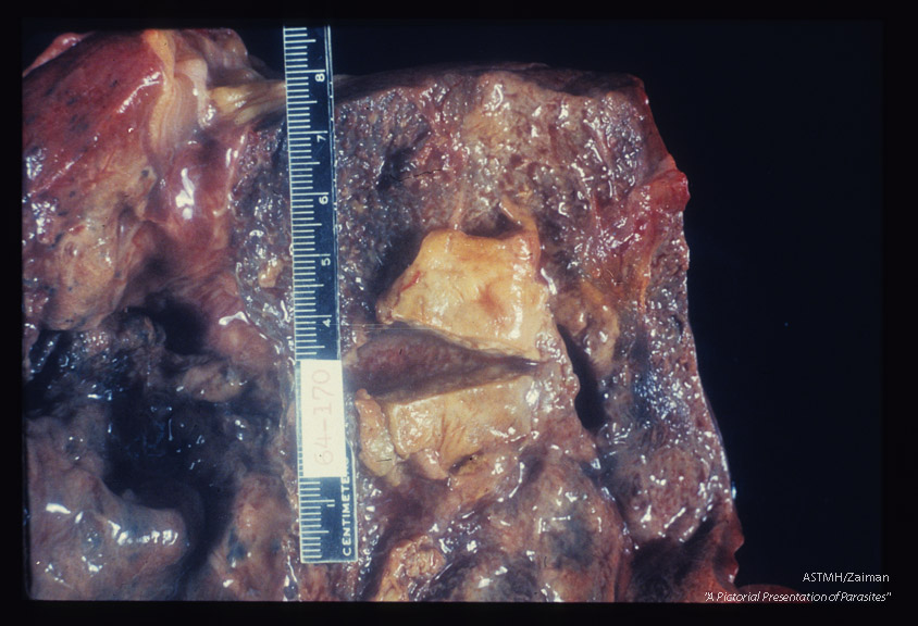 Hepato-pulmonary abscess communicating with bronchus.