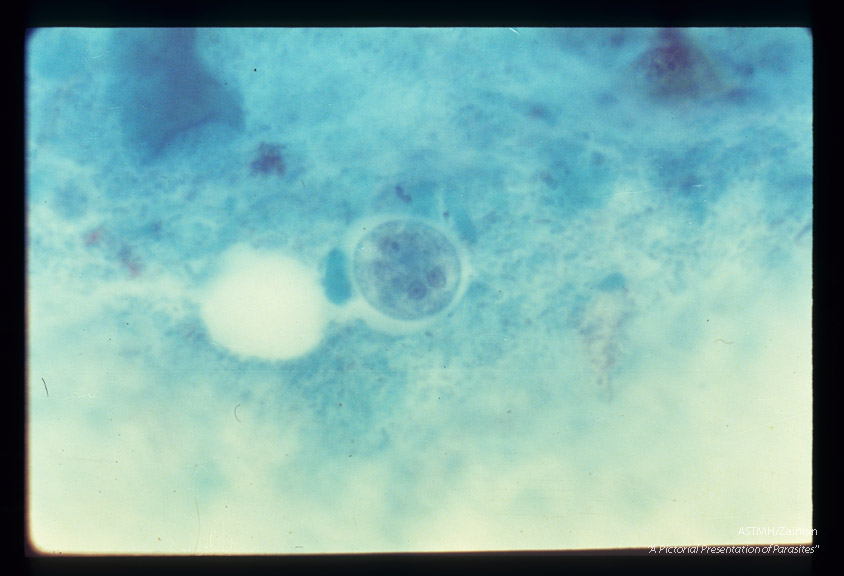 Cyst in stool, Trichrome stain.
