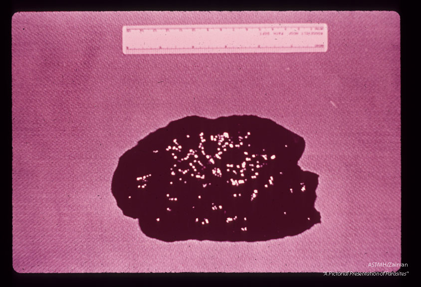 A 69 year old white male received 10 pints of blood shortly before,  during and after gastrectomy for a   benign gastric ulcer.    One of the donors,  a previously infected veteran of the Viet Nam war, registered at the blood bank under a false name and addrer Approximately four weeks after the surgery the patient developed a fatal case of falciparum malaria.  The enlarged, heavily pigmented spleen is seen in gross section.