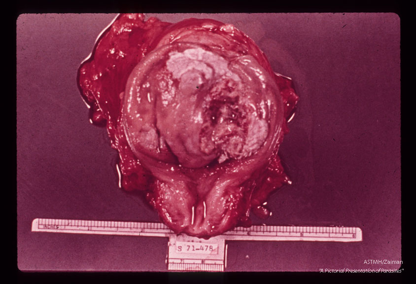 Egyptian male, 26 years old. Surgically excised urinary bladder, containing 156,000 eggs per gram of host tissue-. Eighteen pairs of adults wore recovered from the specimen. The pearly white area near the apex is indicative of squamous metaplasia. The largo ulcerated mass on the right side of the bladder is a squamous cell carcinoma. The tan surface of the remainder of the bladder is a mass of confluent sandy (granulomatous) patches.