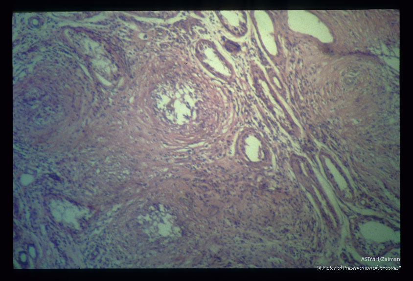 Gross and microscopic photos showing granulomatous formations in testicle as well as adult worm in the pampiniform plexus.