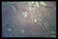 Gross and microscopic photos showing granulomatous formations in testicle as well as adult worm in the pampiniform plexus.