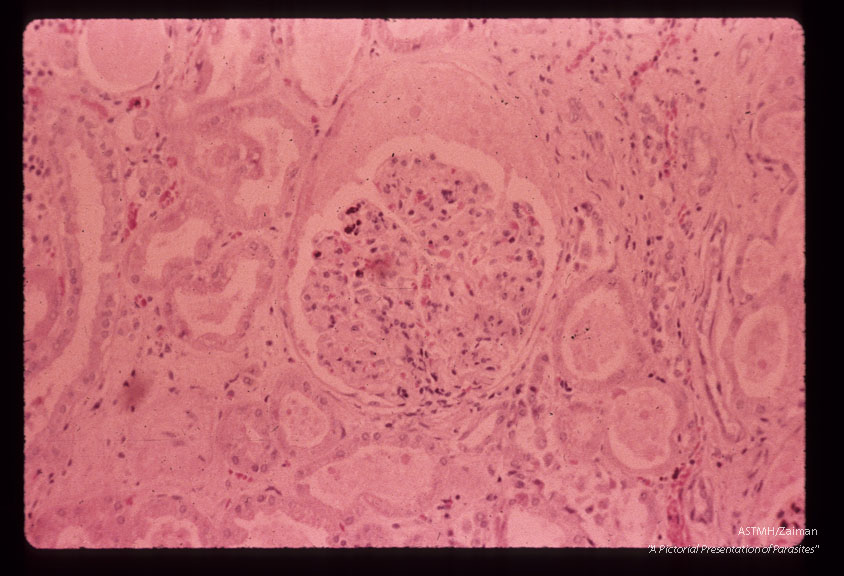 A 69 year old white male received 10 pints of blood shortly before,  during and after gastrectomy for a   benign gastric ulcer.    One of the donors,  a previously infected veteran of the Viet Nam war, registered at the blood bank under a false name and addrer Approximately four weeks after the surgery the patient developed a fatal case of falciparum malaria.  Giemsa stained section of kidneys showing lobular proliferation with mesangeal cells plus pigment deposits. Protein present in Bowman's space. Hydropic changes are present in tubular epithelium.