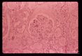 A 69 year old white male received 10 pints of blood shortly before,  during and after gastrectomy for a   benign gastric ulcer.    One of the donors,  a previously infected veteran of the Viet Nam war, registered at the blood bank under a false name and addrer Approximately four weeks after the surgery the patient developed a fatal case of falciparum malaria.  Giemsa stained section of kidneys showing lobular proliferation with mesangeal cells plus pigment deposits. Protein present in Bowman's space. Hydropic changes are present in tubular epithelium.