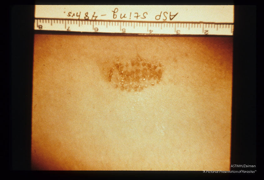 Evolution of dermatitis produced by venom introduced into human skin by hollow larval poisonous spines. Twenty -four hours after exposure.