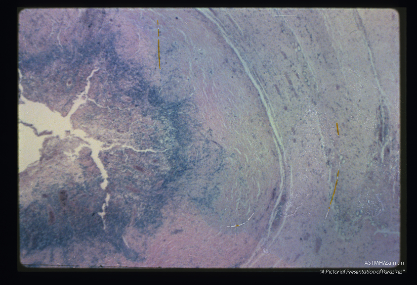 Human brain. The empty space in the photograph is the abscess cavity which contained the parasite. The tissue shows a marked inflammatory reaction (blue) and brain replacement. Small round or oval spaces surrounded by refractile substances are the remains of eggs trapped in the tissue.