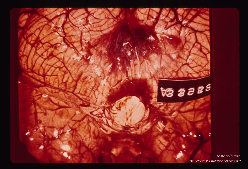 Lee case of primary amoebic meningoencephalitis. Whole brain.