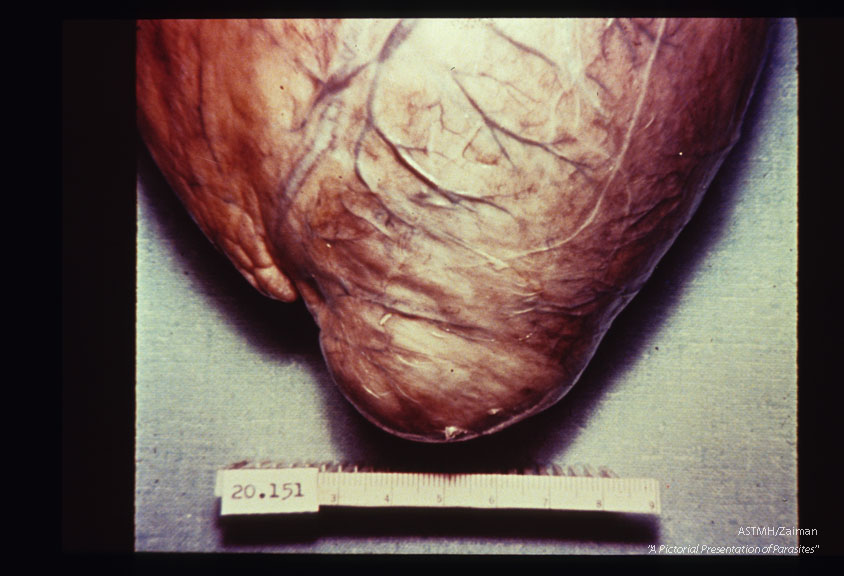 Multiple specimens showing aneurysmal dilatation and thinning of the apical myocardium, plus marked concentric muscular hypertrophy.