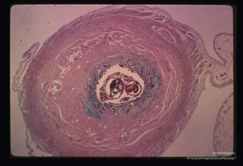 Human appendix. Within the lumen of the appendix, one sees cross sections of a nematode with markedly different diameters.