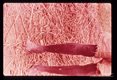 Depigmentation of skin secondary to infection and stasis.