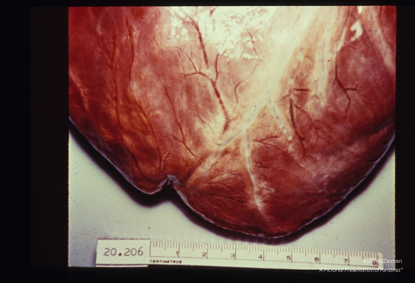 Multiple specimens showing aneurysmal dilatation and thinning of the apical myocardium, plus marked concentric muscular hypertrophy.