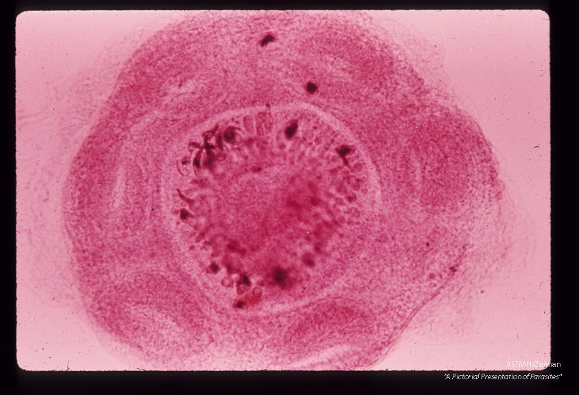 A 32 month old white male in South Dakota suffered progressive lassitude,   anorexia,   irritability,   incoordination and infrequent vomiting.  A suboccipital craniotomy was performed during which a grape-like mass of translucent thin wall cysts was discovered and partially evacuated with difficulty.  Subsequently patient developed flexion rigidity of the  extremities,  non-reactive pupils and decreased consciousness.  A sinus tract at the operative site con­tained more cysts.  The patient died three months after the onset of symptoms.  Higher power views of one scolex.