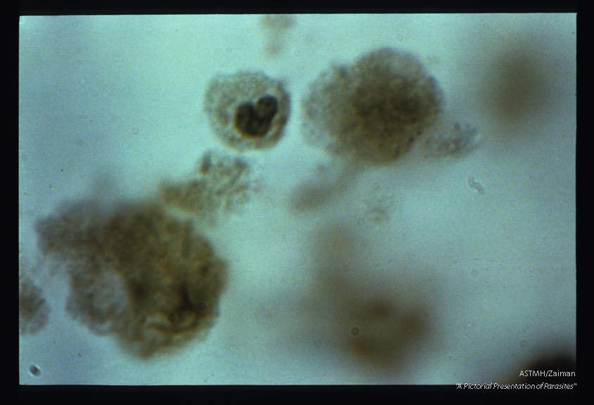 The leucocyte had been identified as a cyst ot Entamoeba histolytica during examination of a stool.
