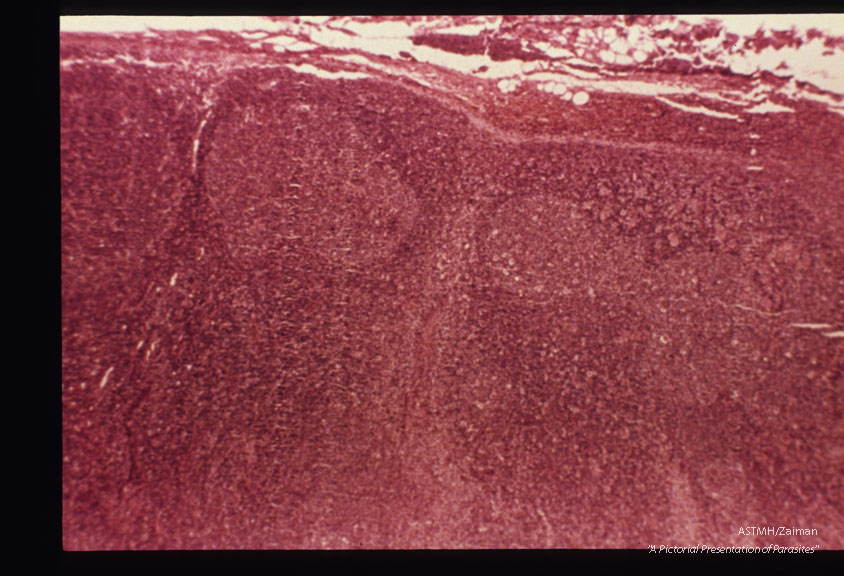 Toxoplasma lymphadenitis with lymphoreticular hyperplasia. H&E stain.