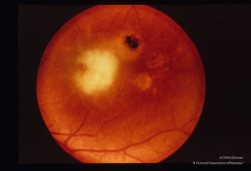 Old and new lesions of retinochoroiditis .