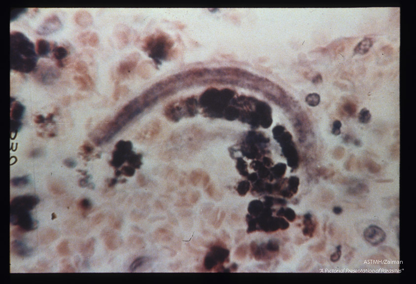 Hematoxylin-eosin stained section of human lung showing larva in alveolus.