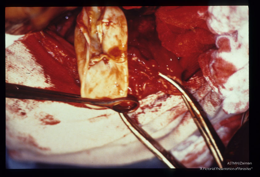 A 26 year old Italian male presented with jaundice due to biliary tree obstructions by daughter cysts of Echinoccocus granulosus. Picture sequence of operative dissection. Removal of cysts, placement of multiple drains and creation of several anastomoses were required to ensure proper biliary drainage and to prevent bile peritonitis.