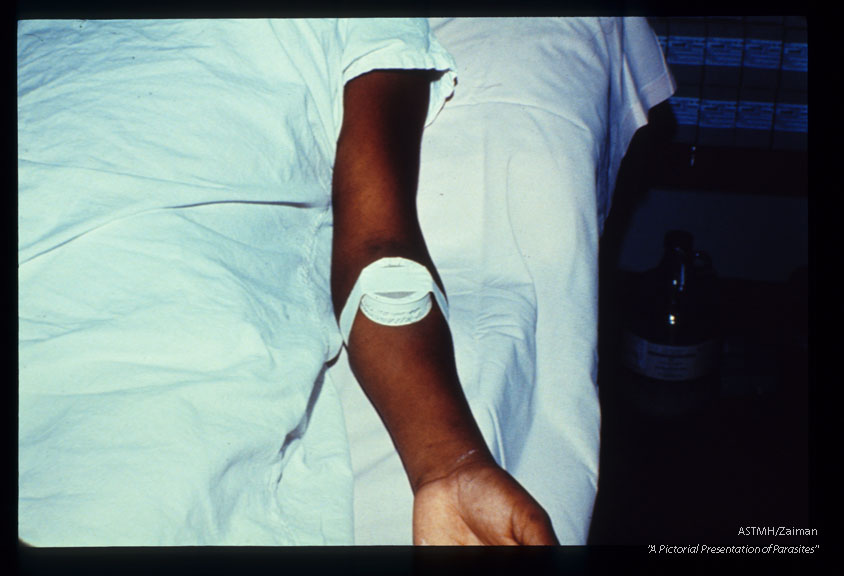 Sequence shows an empty cage (1114) within which are placed uninfected reduviid bugs for xenodiagnosis. This is attached to the forearm with tape (1115). The bugs are permitted to bite the patient, are removed (1116), maintained for a while, then sacrificed. Proctodeum is then dissected for parasites.