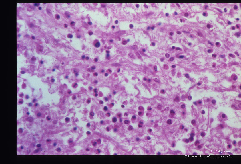 Same case. Eosinophilic encephalitis.