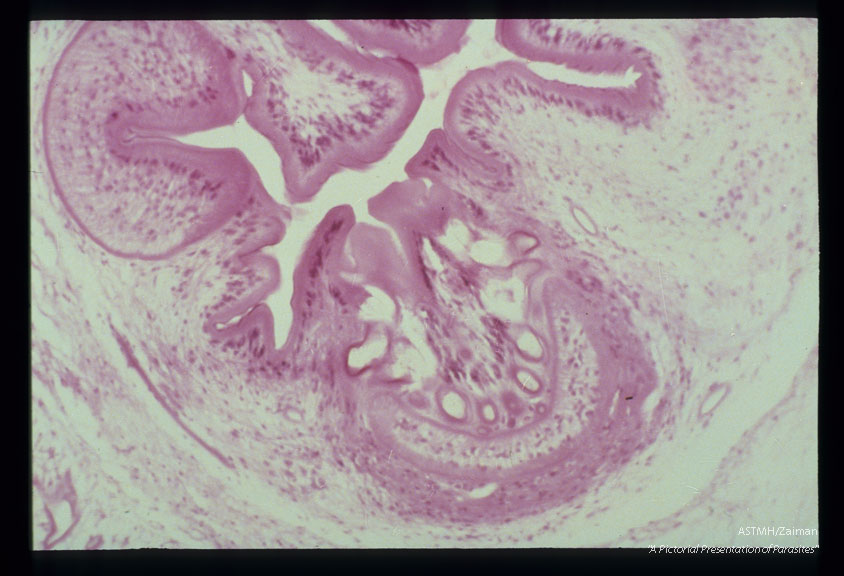 Photomicrographs of a subcutaneous nodule in a patient.