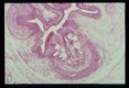 Photomicrographs of a subcutaneous nodule in a patient.