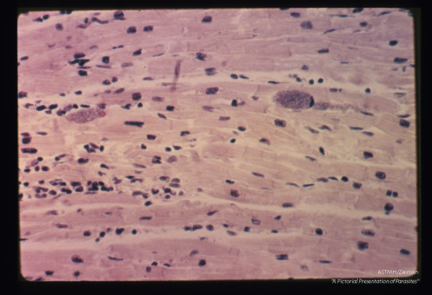 Pseudocysts in human heart. This low power view shows two pseudocysts in the myocardium of an adult patient who had a concommitant blood dyscrasia. Numerous organisms are present in each of the cysts. One of the pseudocysts has a tail-like extension.