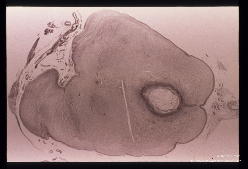 Encephalitis. Pons with necrosis around aqueduct which is obstructed leading to periventricular necrosis in the ventricular system anterior to it.