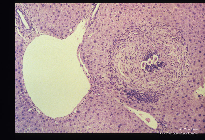 Mouse. BALB/c-Experimental infection, chronic, with 500 infective T. canis eggs per os. Liver. At 8 months PI this coTled larva is present within a large, well-organized fibrotic granuloma. HE, x 100.