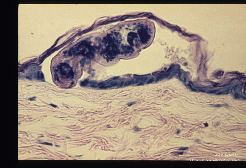 Cercaria migrating under the stratum corneum a few minutes after entry.