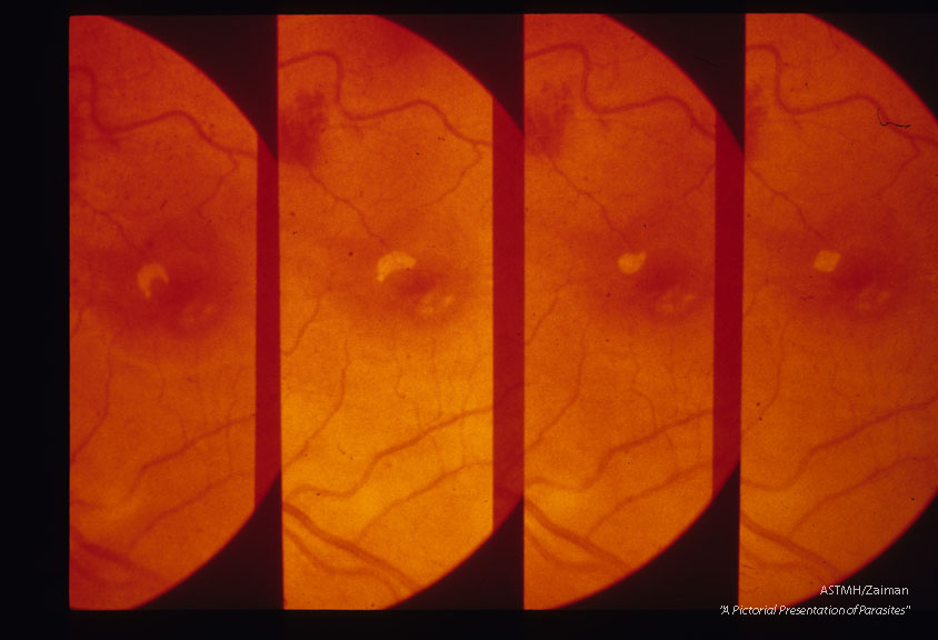 In human eye. Changes in shape of trematode during a two-second period. Worm was stimulated into activity by heat from light of opthalmoscope.