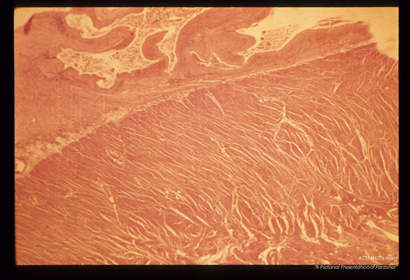 Granulomatous reaction around eggs in pericardium.