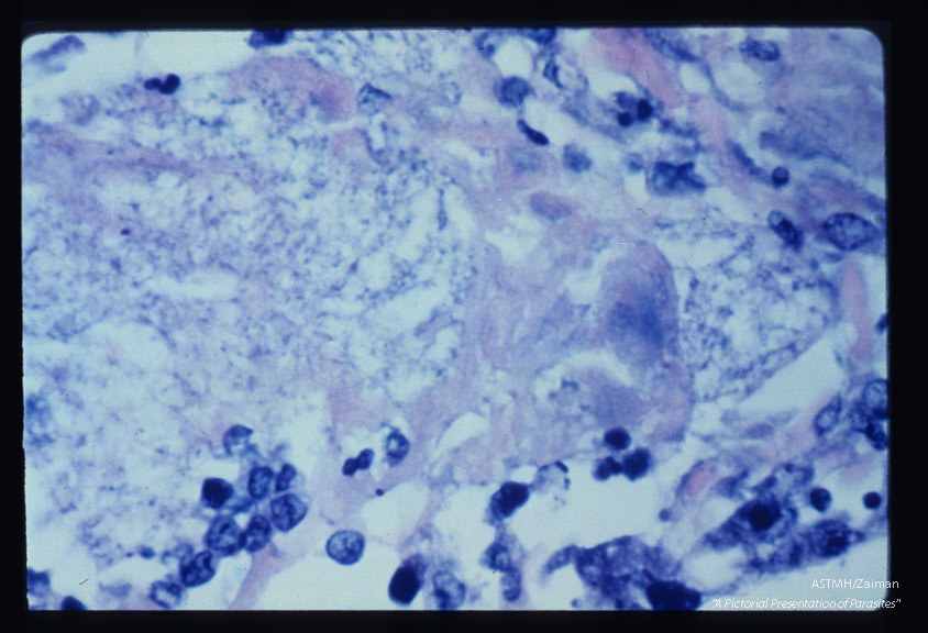 Pneumonia. Low power view of infected lung stained with silver methenamine. Some parasites stain better than others.