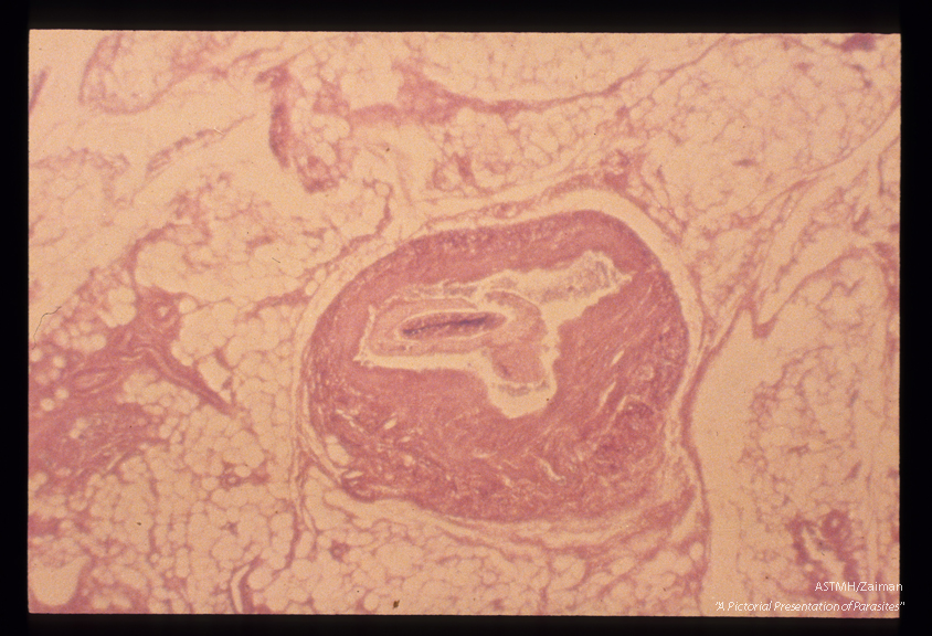 Adults in a mesenteric vein. Note the intimal thickening of the vein.