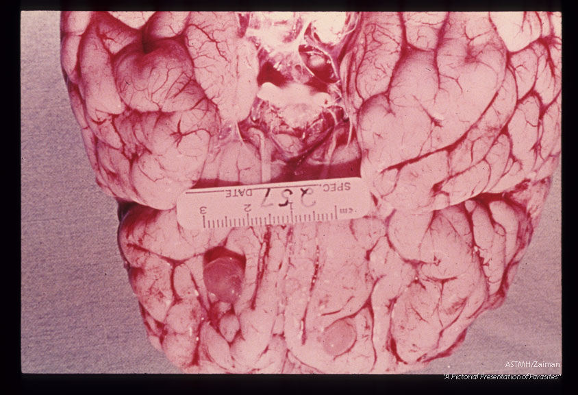 Asymptomatic cerebral cysticercosis.