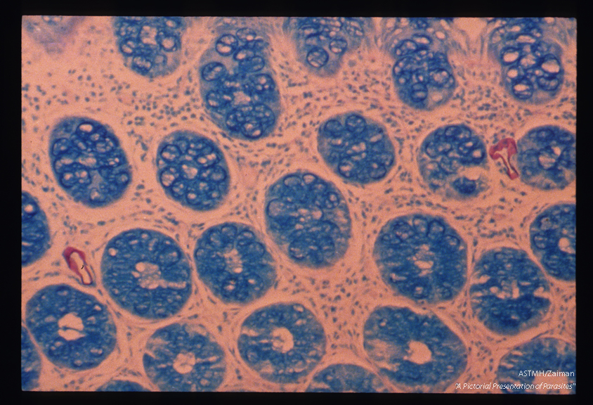 Rectal biopsy showing that the egg shells are acid-fast (red).