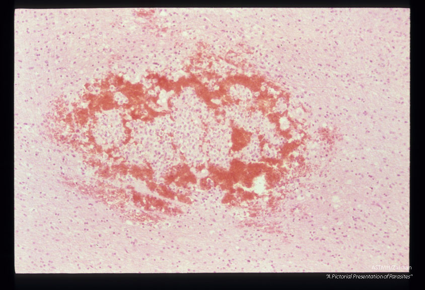 Hemorrhage, hemorrhagic migration tract and macrophage infiltration in cerebrum of an experi­mentally infected squirrel monkey.