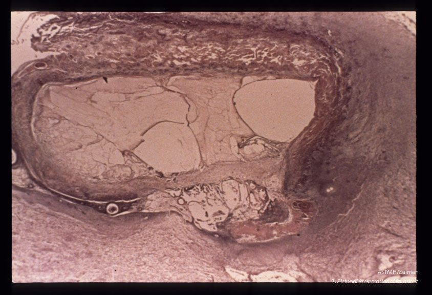 Encephalitis. Necrosis surrounds the lateral ventricle except where the choroid plexus persis This is a typical lesion in toxoplasmosis of the newborn.