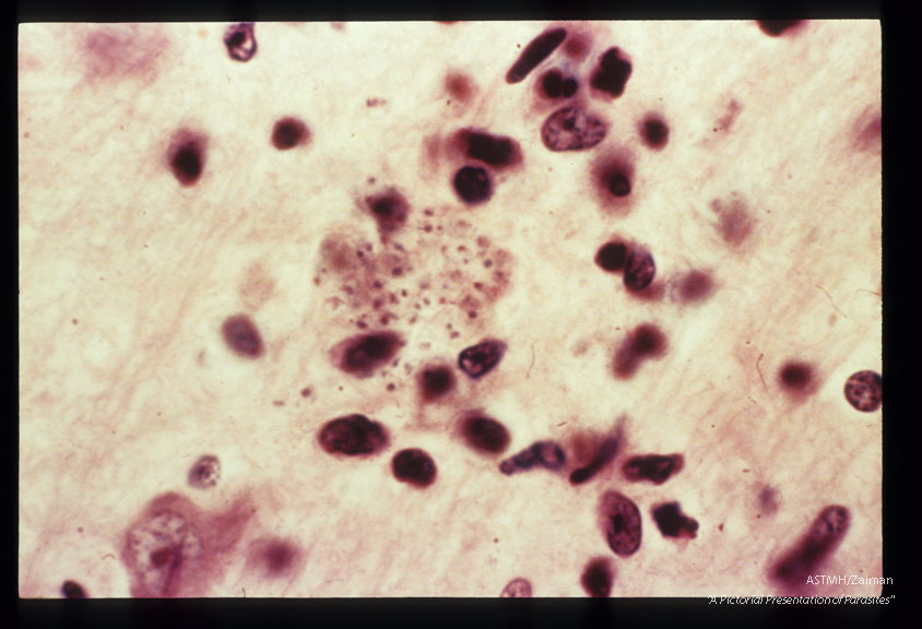 Section of myocardium showing numerous parasites, edema, and inflammatory infiltrate.