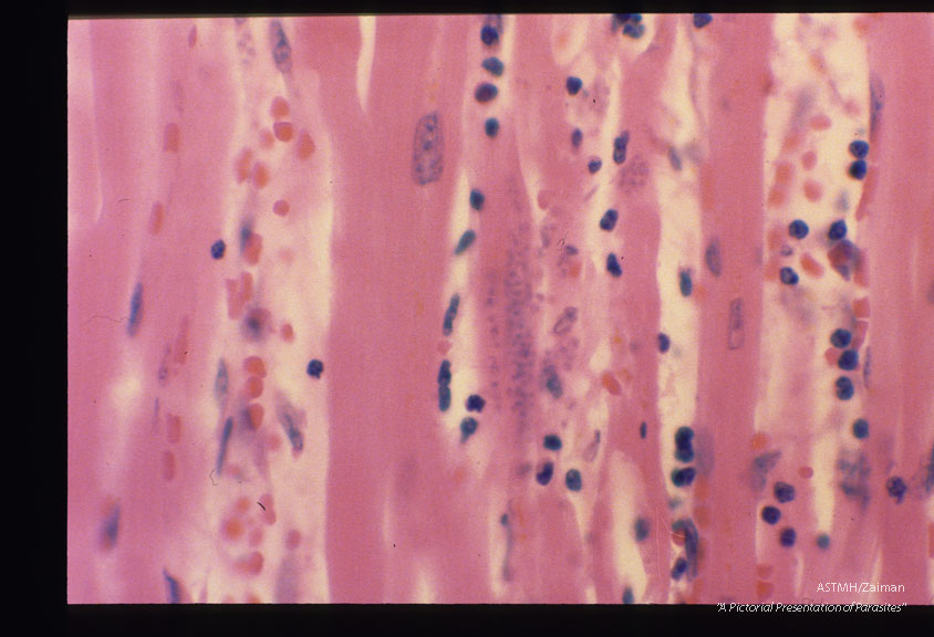 A cardiac recipient received a heart which harbored Toxoplasma and died thereof. Prior to transplantation his serology was negative for Toxoplasma. The parasites are readily visualized in his heart.