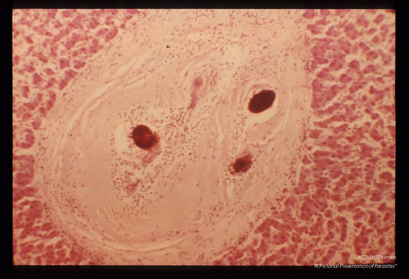 Liver with fibrotic nodule containing calcified eggs.