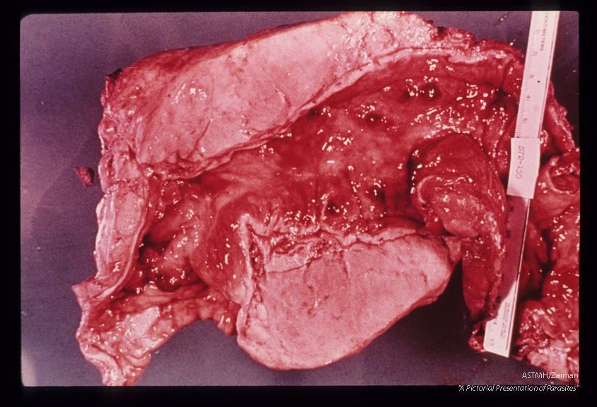 Hemicolectomy specimen from 40 year old Egyptian male showing large bilharzioma adjacent to the rectosigmoid colon. Several polyps were present in the intestine. The bilharzioma was composed mainly of fibrotic granulomas, About 23, 000 S. mansoni eggs and 1, 500 S. haematobium eggs per gram of polyp and/or bilharzioma were present. Irregular fibrous masses were present in the colonic serosa as well. Numerous S. mansoni adults were found in the specimen. Surgery was scheduled to provide relief from urinary tract obstruction (right ureter) caused by S. haematobium. The colon was resected because the mass was suspected to be cancer.