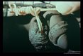 Extraction of adults from scrotum.