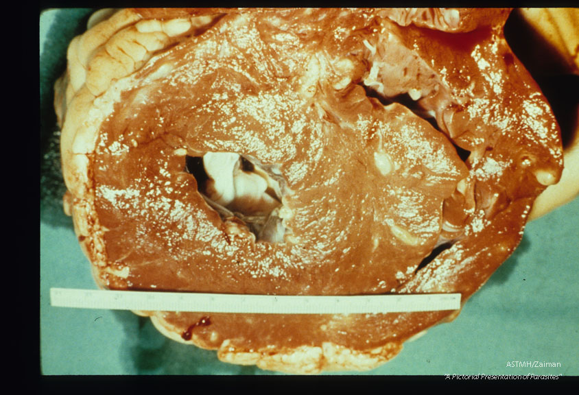 Beef heart harboring multiple cysticerci. Gross specimen.