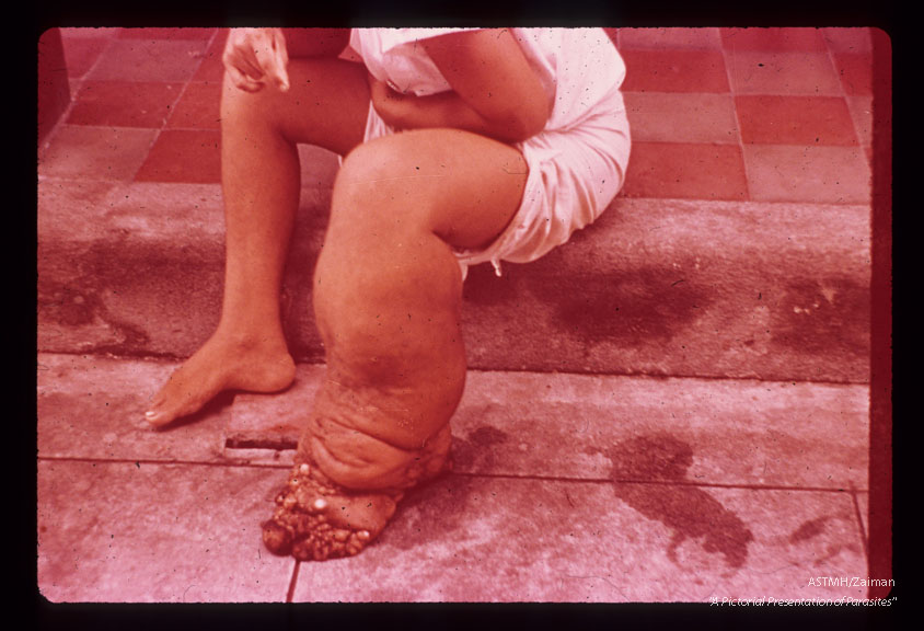 Elephantiasis of lower extremities.