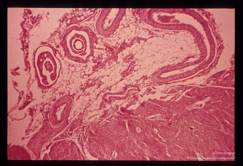 Paired adult males and females in the mesenteric veins of a patient. Two veins, each containing a male worm embracing a female, are seen in the lower right corner of the slide.