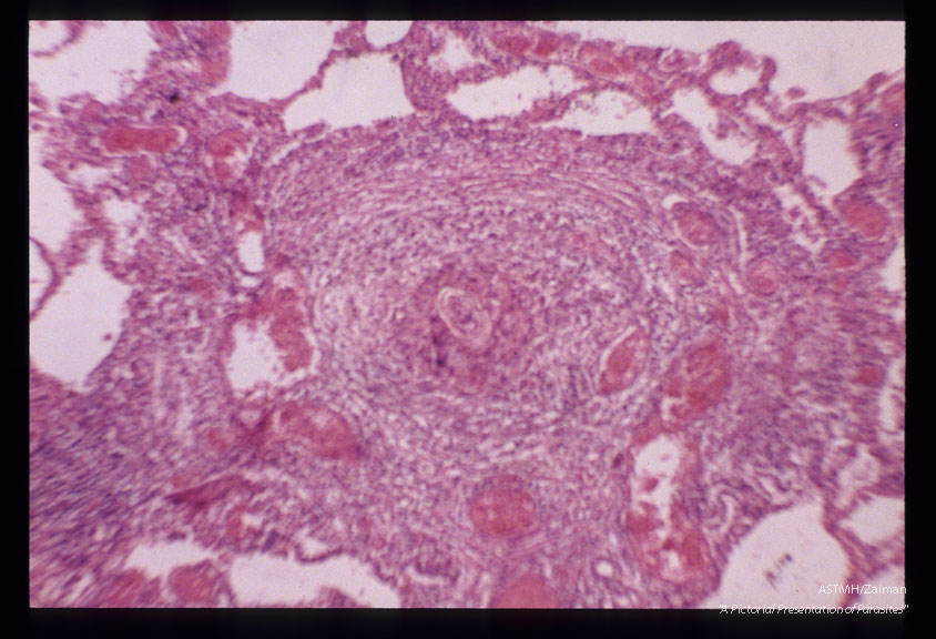 H & E stained lung sections showing an egg containing granuloma with multiple angiomatoid vessels. Fatal case of pulmonary fibrosis. Same case as slide 24.