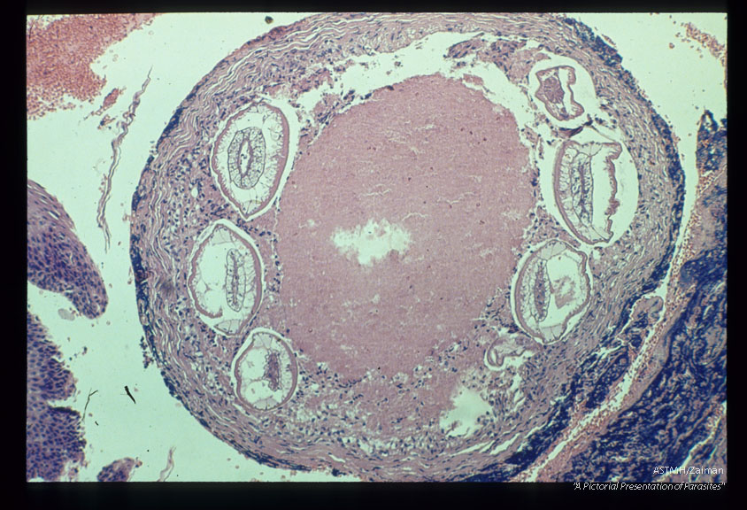 Encapsulated larvae in submucosa of resected tonsil.